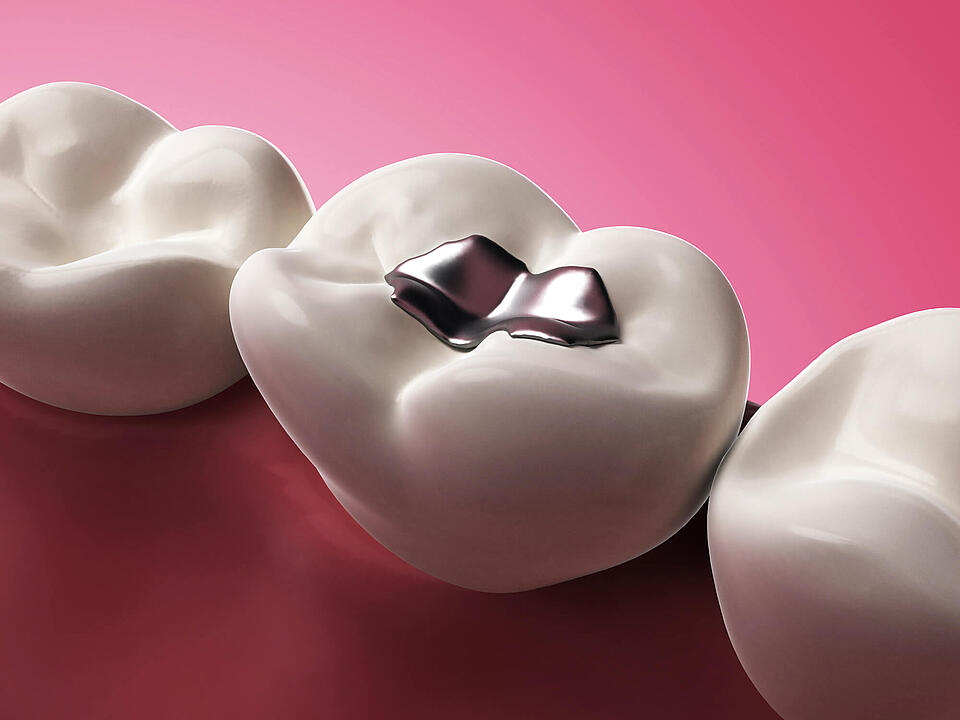 Amalgam: Unbedenkliche Zahnfüllung oder gefährliches Risiko?