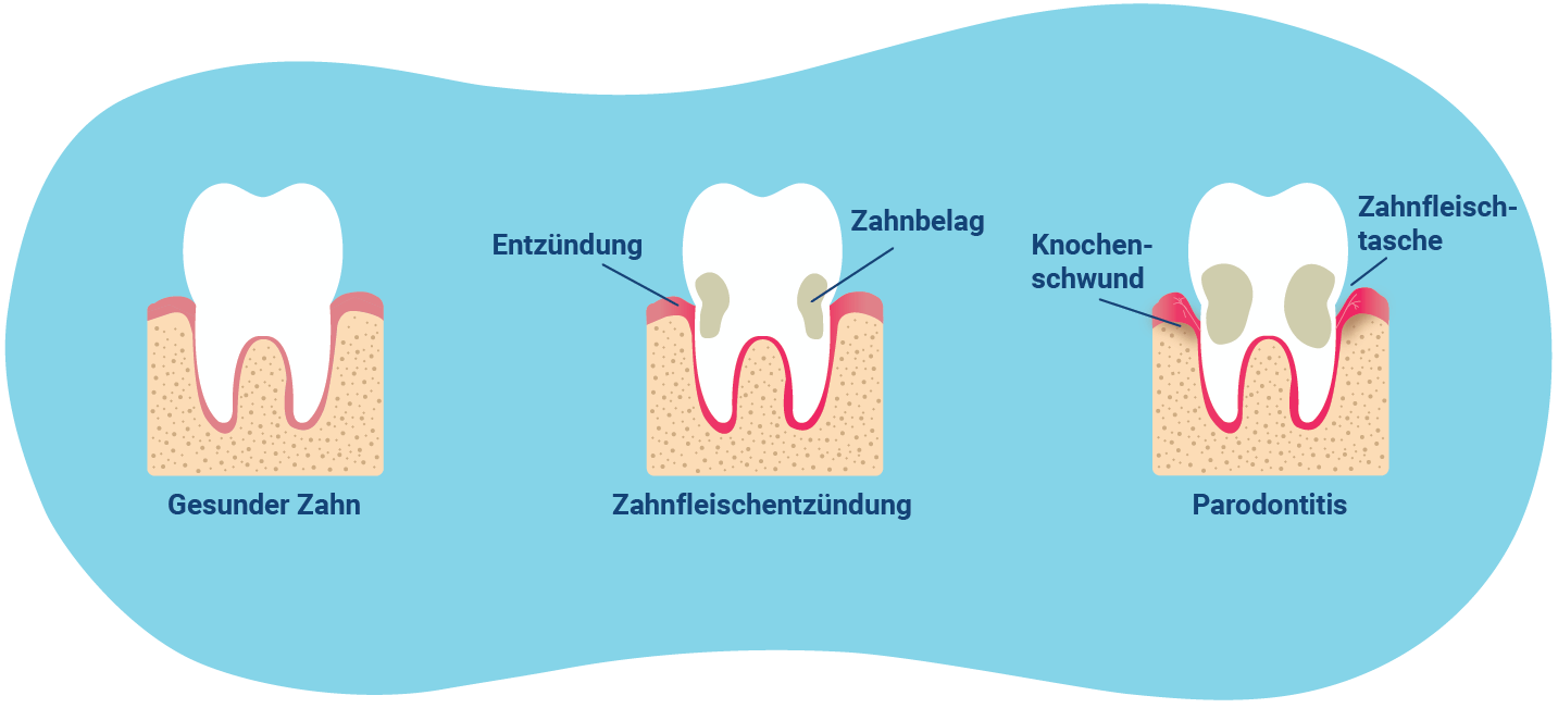 Darstellung eines gesunden Zahnes im Vergleich zu Zahnfleischentzündung und Parodontitis