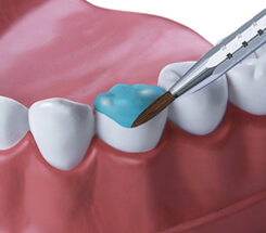 Professionelle Zahnreinigung Prophylaxe Ablauf Vorteile Kosten