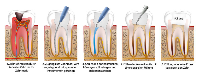 Zahnwurzelentzundung Ursachen Symptome Behandlung